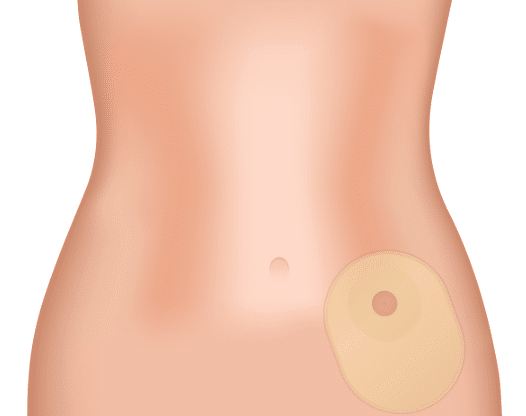 5 FAQs About an Ostomy  180 Medical Ostomy Specialists