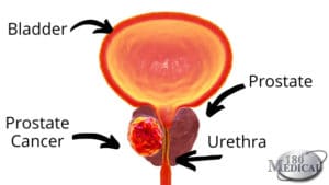 Men's Health Month: Focus on Prostate Cancer | 180 Medical